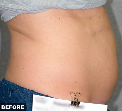 Before Liposonix