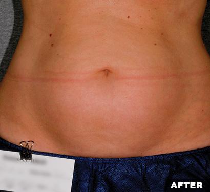 After Liposonix