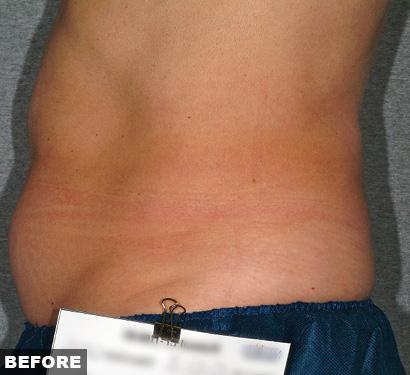 Before Liposonix