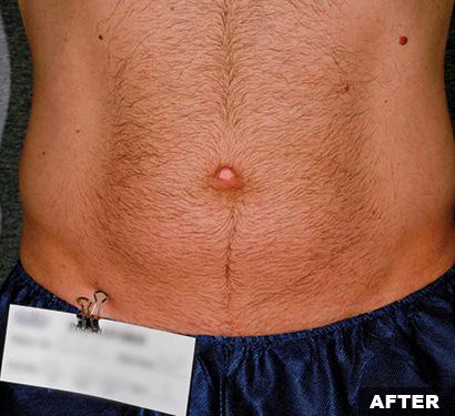 After Liposonix