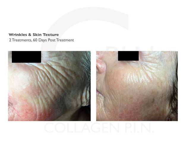 microneedling treatments in queens nyc collagen p i n long microneedling treatments in queens nyc collagen p i n long