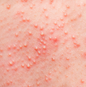 contact dermatitis explained advanced dermatology blog contact dermatitis explained advanced dermatology blog