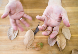 No family link seen between Parkinson’s, melanoma