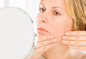 ZAPPING ZITS: Expert Discusses Non-Medication Treatments for Acne