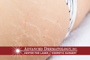 ADVANCED DERMATOLOGY PC’S MEDICAL DIRECTOR, JOSHUA L. FOX, M.D., SPEAKS ON STRETCH MARKS