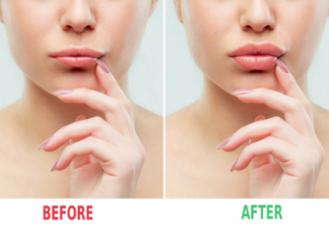 Fillers for lip augmentations are now approved!