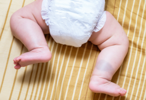 Birthmark Removal – Should Your Baby Go Under the Knife?
