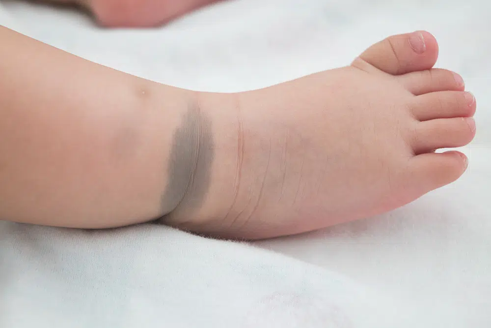 Baby's foot with birthmark