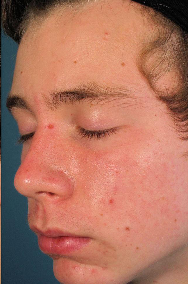 Acleara Acne Therapy, Queens Long Island, NYC