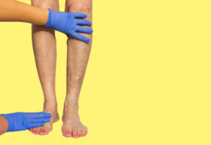 Skin Cell Spray to Treat Venous Leg Ulcers?