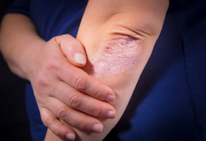 Can Psoriasis Increase One’s Risk of Diabetes?