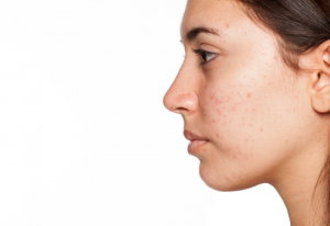 Acne-Killing Virus?