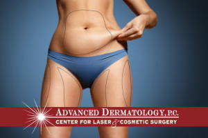 Bella Contour Fat Reduction and Cellulite Treatment