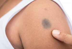 New Port Wine Stain Treatment Option