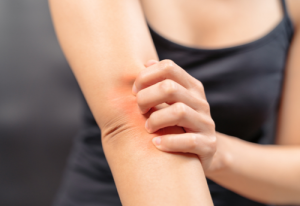Decoding the Mystery Behind Eczema’s Itch: One Step Closer