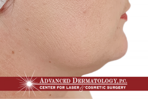 Beauty News: How to Get Rid of a Double Chin Without a Facelift