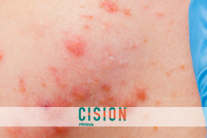 NY Dermatologist Joshua Fox, MD, Offers Tips on Treatment Options for Acute and Chronic Hives Today