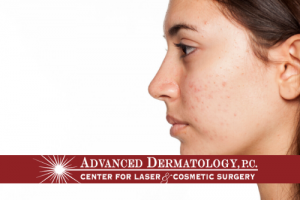Announcing New Acne Therapy and Treatment at Advanced Dermatology’s Simply Posh Aesthetic Spa