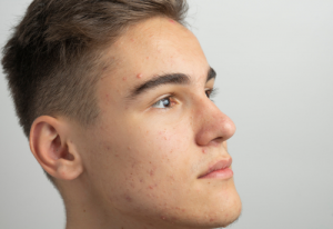 Teen Acne: How to Choose the Best Treatment