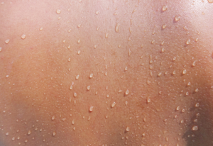 Sweat a Lot? It’s (Most Likely) in Your Genes!