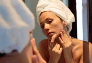 Acne Treatment – How Long Will You Really Need?