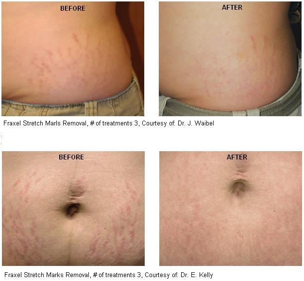 Stretch Mark Bergen County, NJ | Scar Removal Long Island ...