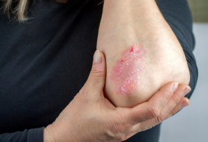 Many Psoriasis Sufferers Discontinue Treatment