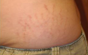 body stretch mark photo