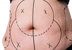 Non-Invasive Fat Removal