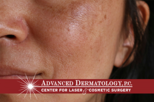 Treating Melasma