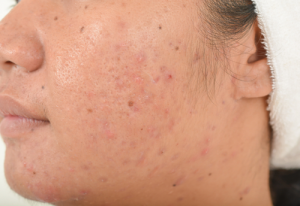 Acne Scarring