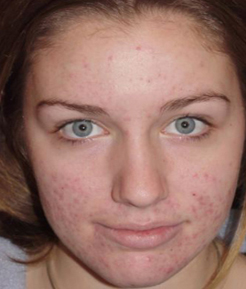 Effects of acne scarring
