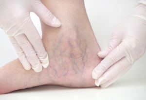 Say goodbye to spider veins this summer!