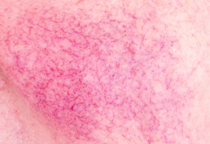 Negative first impressions for rosacea sufferers