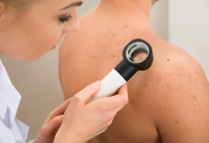 Melanoma Monday