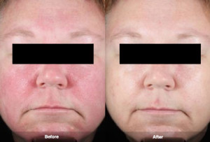 Female face, before and after Rosacea treatment, front view
