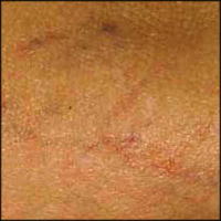 Body area: after spider vein treatment