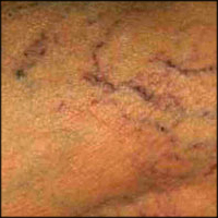 Body area: before spider vein treatment