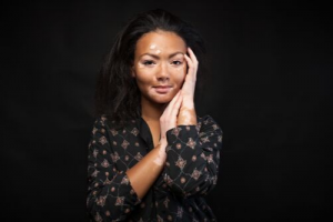 Model embraces her rare skin condition
