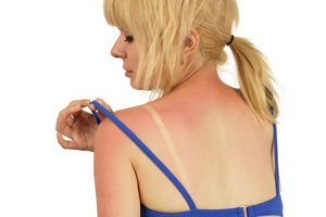 woman sunburn photo