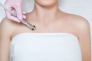 New Treatment Area Approved for Ultherapy