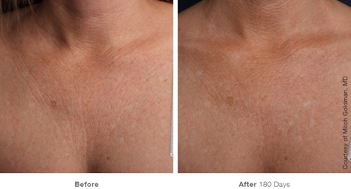 Ultherapy before and after of treatment for decolletage