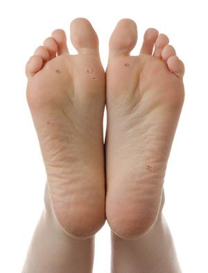 patient feet warts