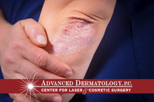10 Tips to Manage Psoriasis and Eczema This Winter