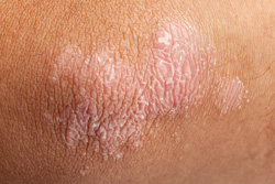 psoriasis photo