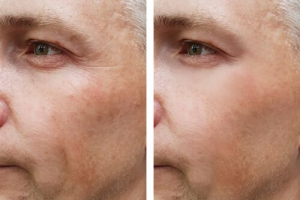 Ulthera Skin Tightening