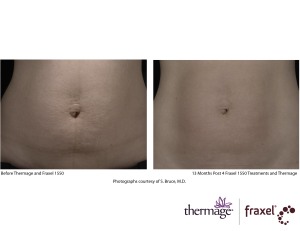 Female stomach, before and after Thermage and Fraxel treatment, front view