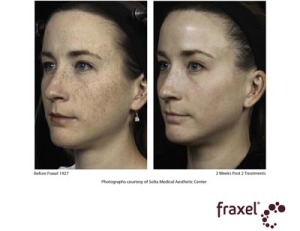 Female face, before and after Fraxel treatment, oblique view, patient 2