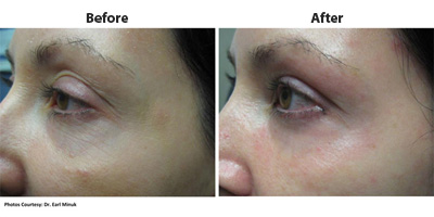 Female face, before and after Pixel CO2 laser treatment, oblique view, patient 1