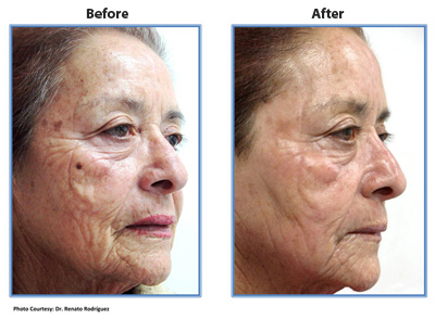 Female face, before and after Pixel CO2 laser treatment, oblique view, patient 2